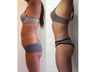 Antes y después de Lipoescultura