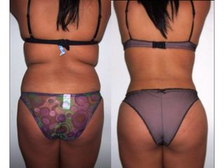 Antes y después de Lipoescultura