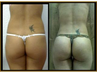 Antes y después de Lipoescultura