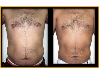 Antes y después de Lipoescultura
