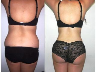 Antes y después de Lipoescultura