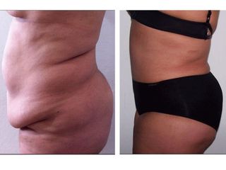 Antes y después de Abdominoplastia