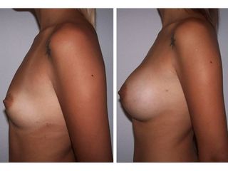 Antes y después de Aumento de busto