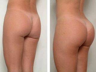 Antes y después de Implantes de glúteos