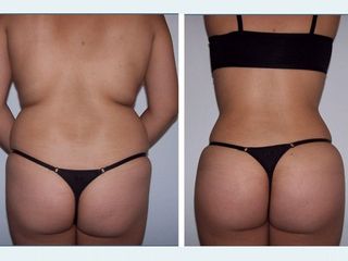 Antes y después de Lipoescultura