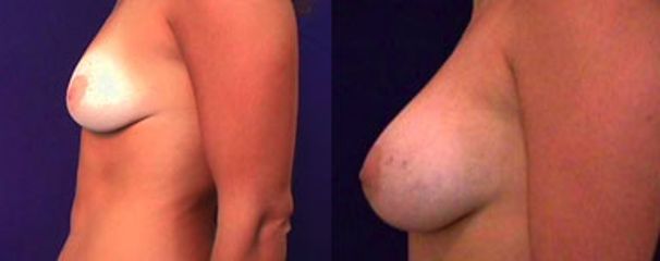 Antes y después de Aumento de busto
