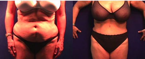 Antes y después de Liposucción