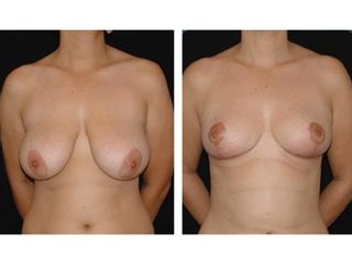 Mastopexia, Dr. Joel Michel