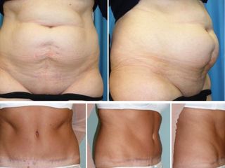 Antes y después de Abdominoplastia tummy tuck 