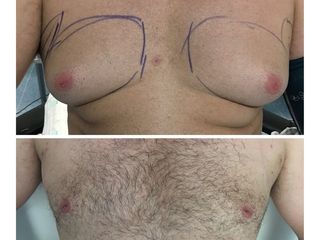 Antes y después de Ginecomastia