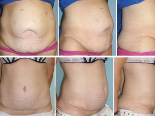 Antes y después de Tummy tuck