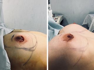 Antes y después de Aumento mamario
