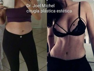 Antes y después de Lipoescultura