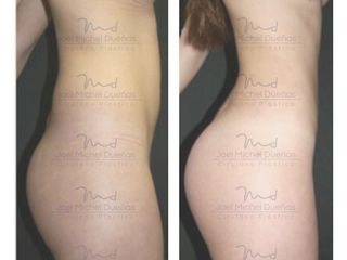 Antes y después de Lipoescultura