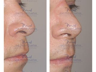 Antes y después de Rinoplastia