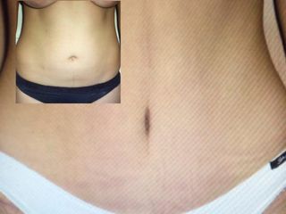 Antes y después de Abdominoplastia 