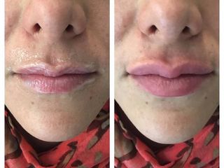 Antes y después de Aumento de labios 