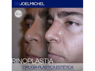 Antes y después de Rinoplastia 