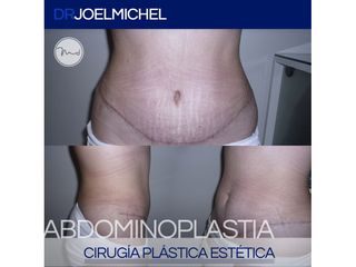 Resultado de Abdominoplastia