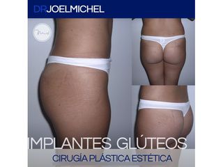 Ante de implantes de glúteos
