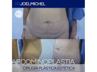 Antes de Abdominoplastia