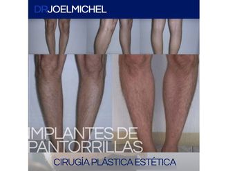Aumento de pantorrillas - 699722