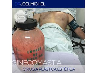 Cirugía de Ginecomastia