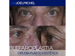 Blefaroplastia