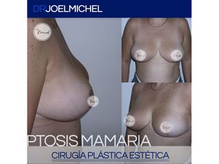 Cirugía de busto