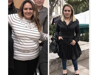 Antes y después de Bypass Gástrico