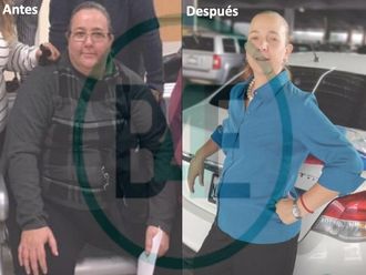 Bypass Gástrico antes y después - 641389