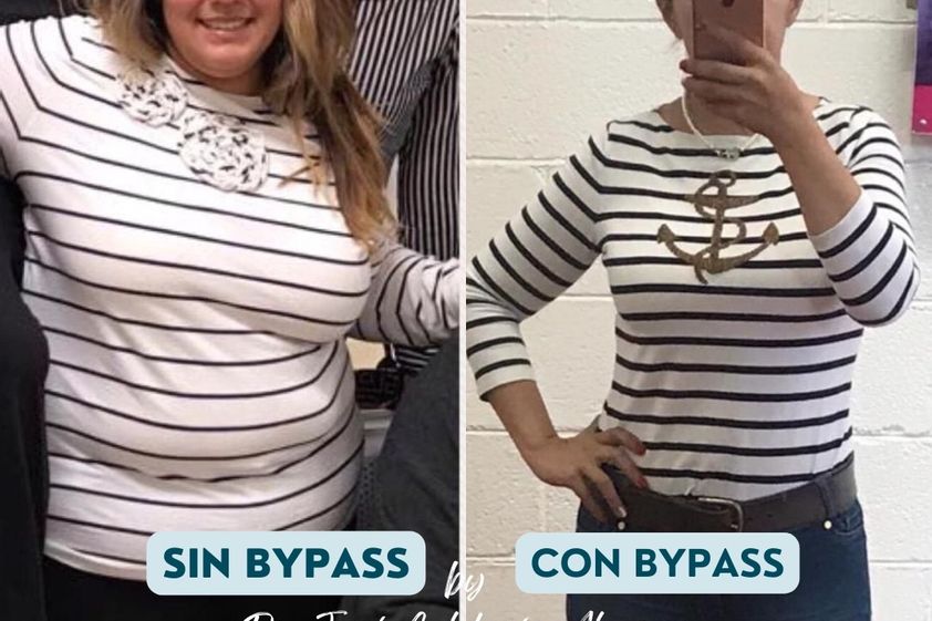 Bypass Gástrico antes y después - 872409