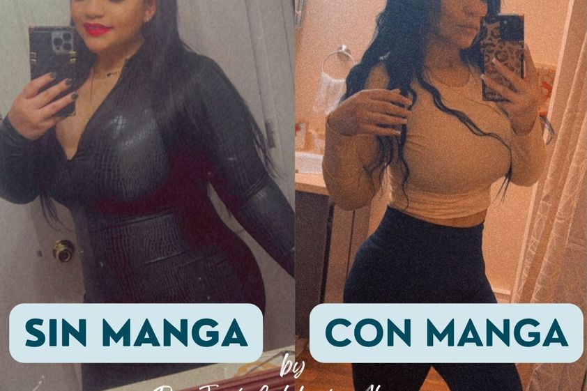 Manga Gástrica antes y después - 872410