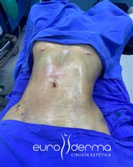 Euroderma