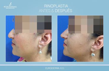 Rinoplastia - Euroderma