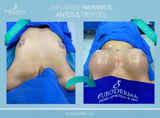 Implantes mamarios se realizan con anestesia local y sedacion alta en 3 horas