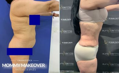 Mommy makeover - Euroderma