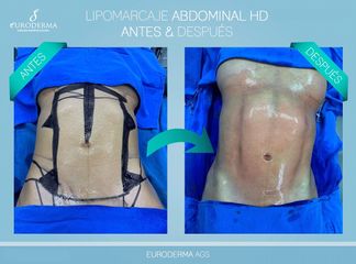Liposucción - Euroderma