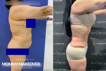 Mommy makeover - Euroderma