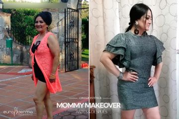 Mommy makeover - Euroderma