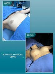 Aumento de busto - Euroderma