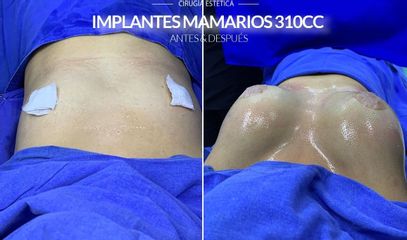Aumento de busto - Euroderma