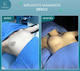 Aumento de busto - Euroderma