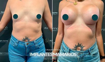 Aumento de busto - Euroderma