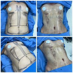 Lipoescultura - Euroderma