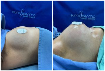 Aumento de busto - Euroderma