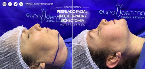 Cirugía de papada - Euroderma
