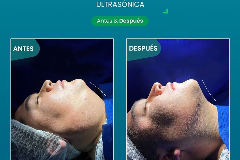 Cirugía de papada antes y después - 867205