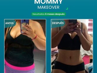 Mommy makeover antes y después - 867208