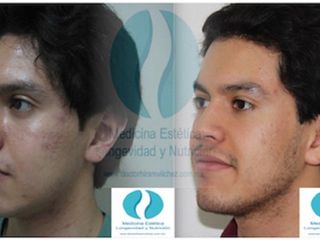 Antes y despues de tratamiento contra el acne